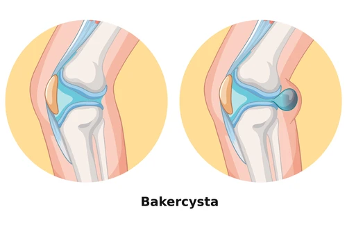 Illustration som visar en normal knäled jämfört med en knäled med Bakercysta bakom knät